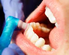 Dental cleaning